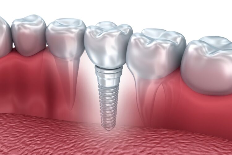 implants in thane