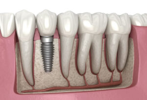 dental implant in thane