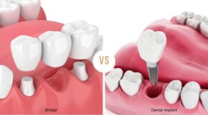 dental implant in thane