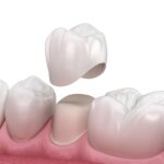 types of tooth crown