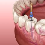 best root canal dentist