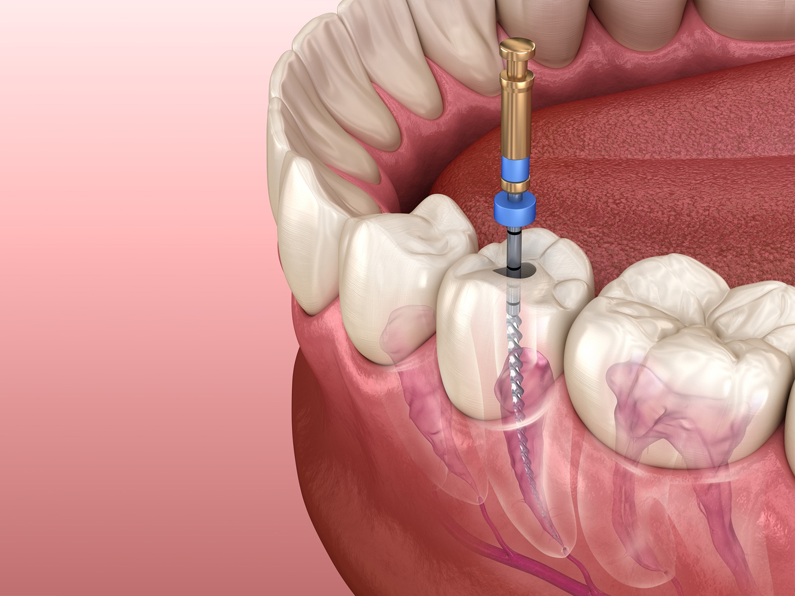 best root canal dentist