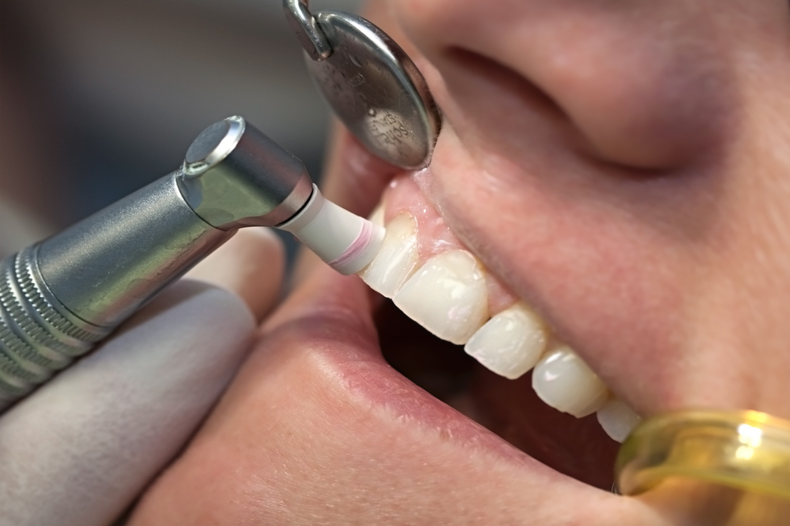teeth cleaning offers near me