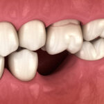 how to replace missing tooth?