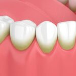 how to make teeth white?